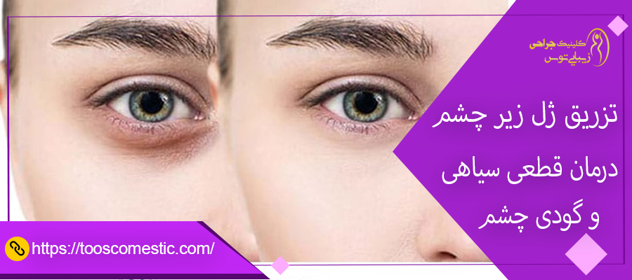 تزریق ژل زیر چشم درمان قطعی سیاهی و گودی چشم